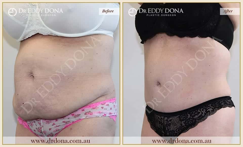 Dr Eddy Dona Plastic Surgery Tummy Tuck Before and After Left Oblique