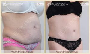 Dr Eddy Dona Plastic Surgery Tummy Tuck Before and After Right Oblique