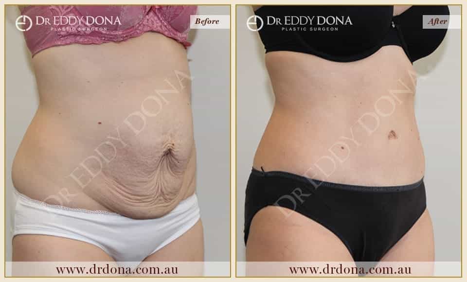 Dr Eddy Dona Plastic Surgery Tummy Tuck Before and After Right Oblique