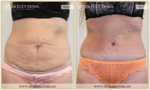 Dr Eddy Dona Plastic Surgery Tummy Tuck Before and After Frontal