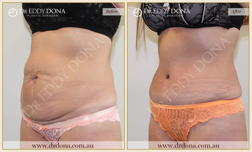 Dr Eddy Dona Plastic Surgery Tummy Tuck Before and After Left Oblique