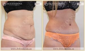 Dr Eddy Dona Plastic Surgery Tummy Tuck Before and After Right Oblique