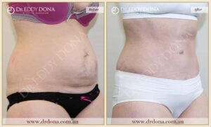 Dr Eddy Dona Plastic Surgery Tummy Tuck Before and After Right Oblique