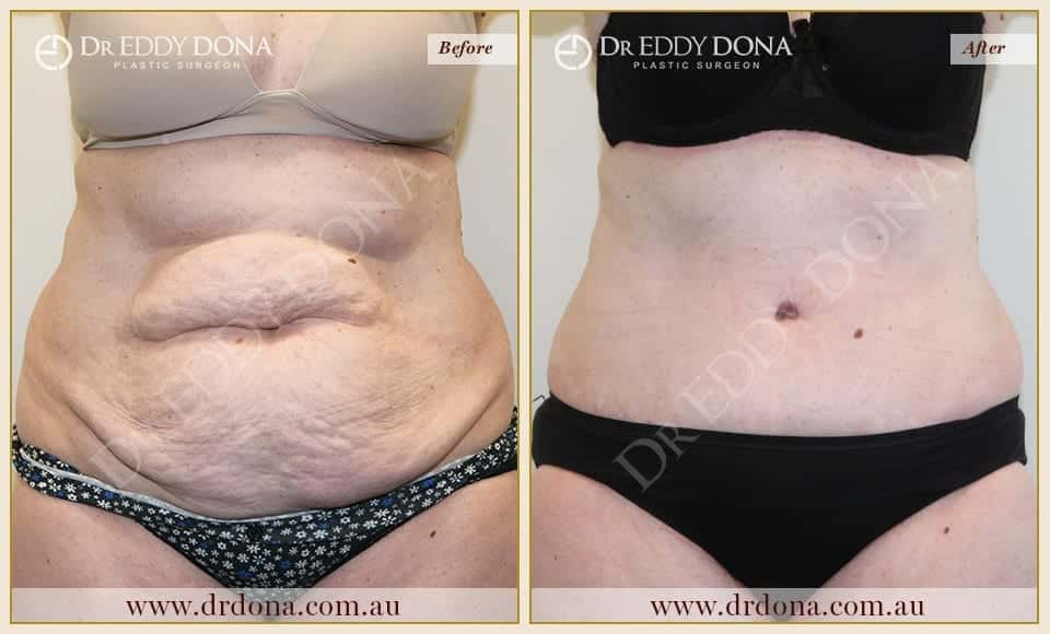 Dr Eddy Dona Plastic Surgery Tummy Tuck Before and After Frontal