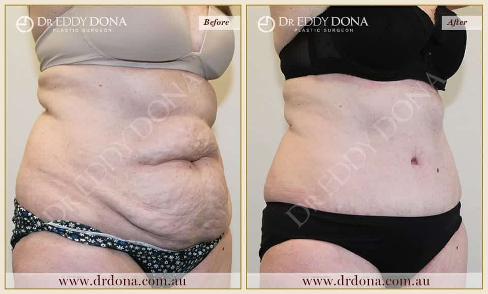 Dr Eddy Dona Plastic Surgery Tummy Tuck Before and After Right Oblique