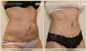 Dr Eddy Dona Plastic Surgery Tummy Tuck Before and After Right Oblique