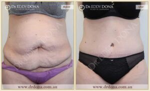 Dr Eddy Dona Plastic Surgery Tummy Tuck Before and After Frontal