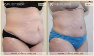 Dr Eddy Dona Plastic Surgery Tummy Tuck Before and After Right Oblique