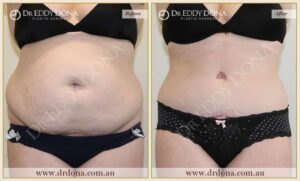 Dr Eddy Dona Plastic Surgery Tummy Tuck Before and After Frontal