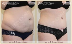 Dr Eddy Dona Plastic Surgery Tummy Tuck Before and After Right Oblique