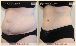 Dr Eddy Dona Plastic Surgery Tummy Tuck Before and After Left Oblique