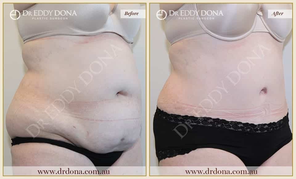 Dr Eddy Dona Plastic Surgery Tummy Tuck Before and After Right Oblique