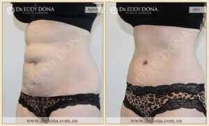 Dr Eddy Dona Plastic Surgery Tummy Tuck Before and After Left Oblique