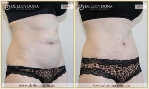 Dr Eddy Dona Plastic Surgery Tummy Tuck Before and After Right Oblique