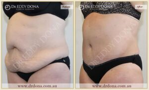 Dr Eddy Dona Plastic Surgery Tummy Tuck Before and After Dr Eddy Dona Plastic Surgery Tummy Tuck Before and After Left Oblique