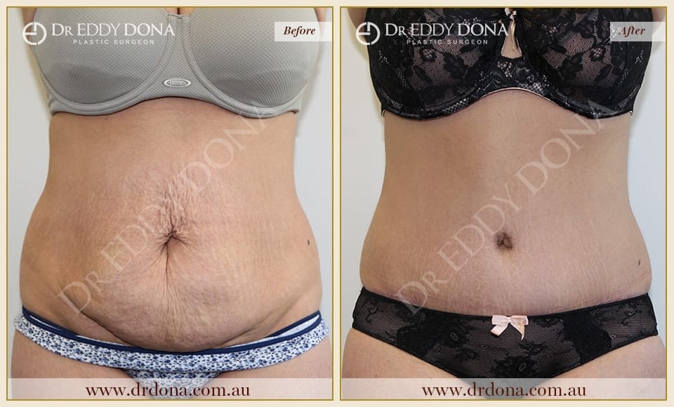 Dr Eddy Dona Plastic Surgery Tummy Tuck Before and After Frontal