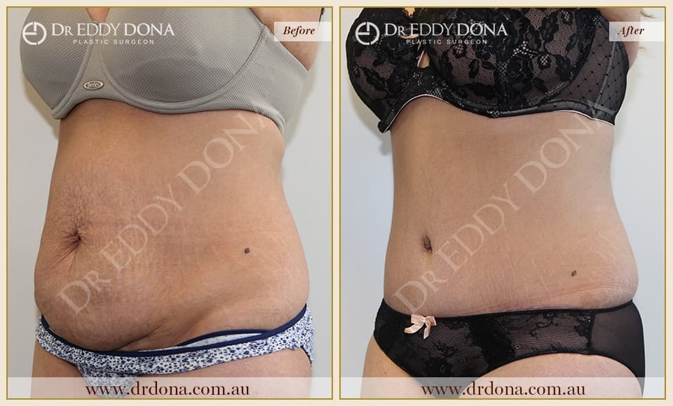 Dr Eddy Dona Plastic Surgery Tummy Tuck Before and After Left Oblique