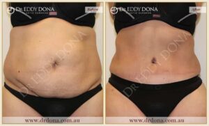 Dr Eddy Dona Plastic Surgery Tummy Tuck Before and After Frontal