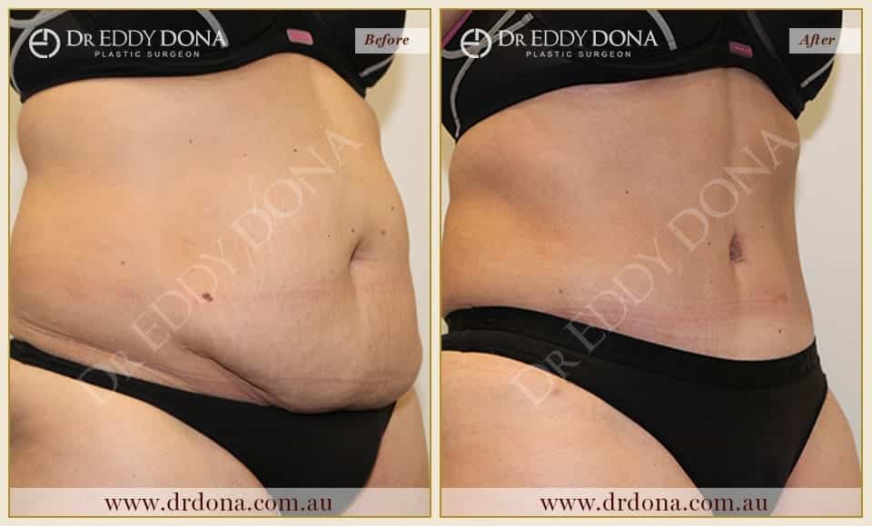 Dr Eddy Dona Plastic Surgery Tummy Tuck Before and After Right Oblique