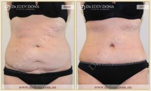 Dr Eddy Dona Plastic Surgery Tummy Tuck Before and After Frontal