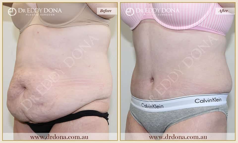 Dr Eddy Dona Plastic Surgery Tummy Tuck Before and After Left Oblique