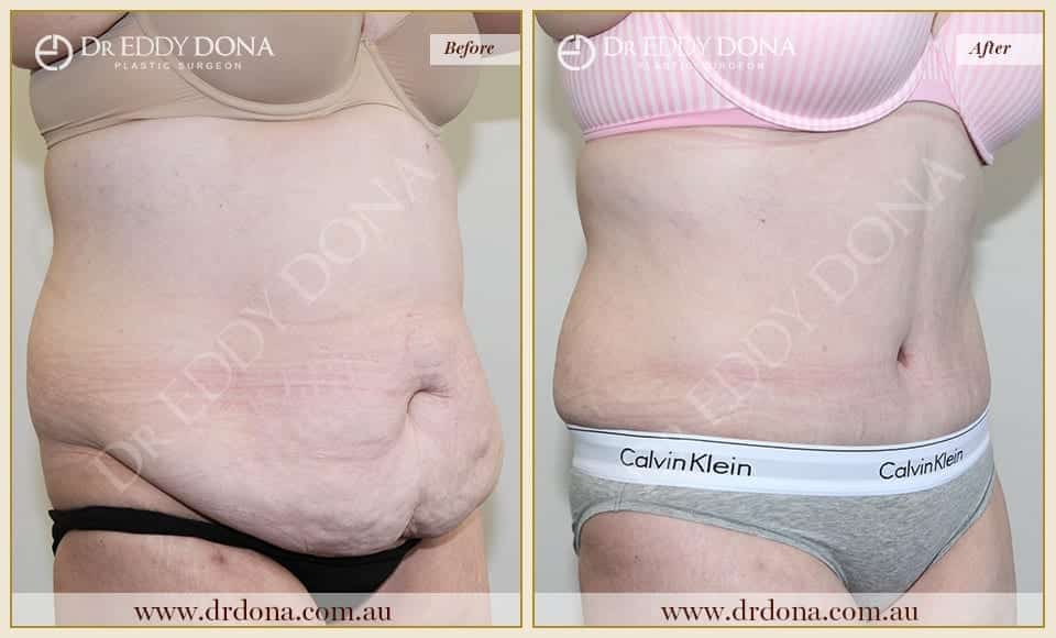 Dr Eddy Dona Plastic Surgery Tummy Tuck Before and After Right Oblique