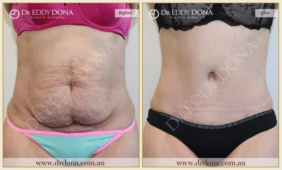 Dr Eddy Dona Plastic Surgery Tummy Tuck Before and After Frontal