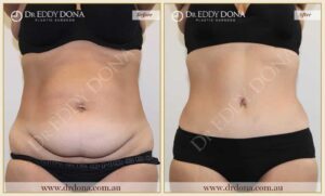 Dr Eddy Dona Plastic Surgery Tummy Tuck Before and After Frontal