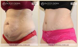 Dr Eddy Dona Plastic Surgery Tummy Tuck Before and After Left Oblique