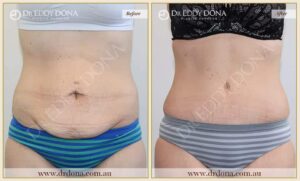 Dr Eddy Dona Plastic Surgery Tummy Tuck Before and After Frontal