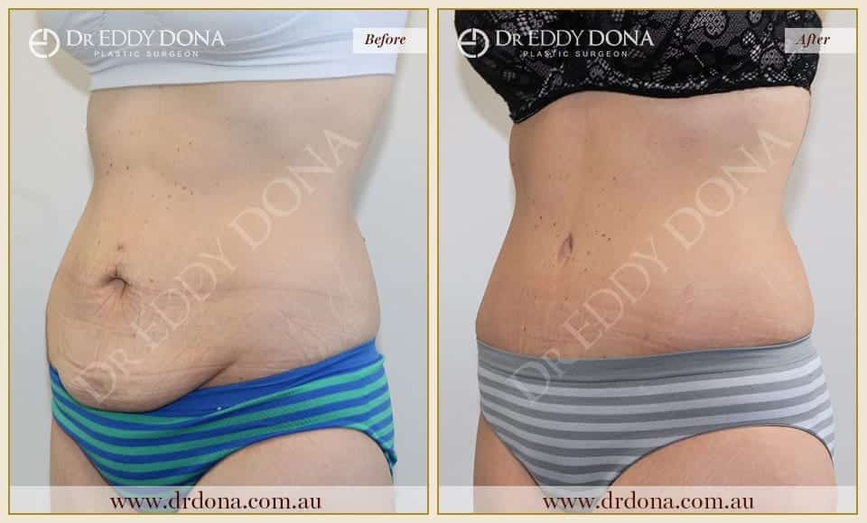 Dr Eddy Dona Plastic Surgery Tummy Tuck Before and After Left Oblique