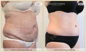 Dr Eddy Dona Plastic Surgery Tummy Tuck Before and After Right Oblique