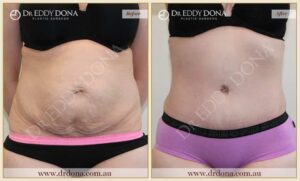 Dr Eddy Dona Plastic Surgery Tummy Tuck Before and After Frontal