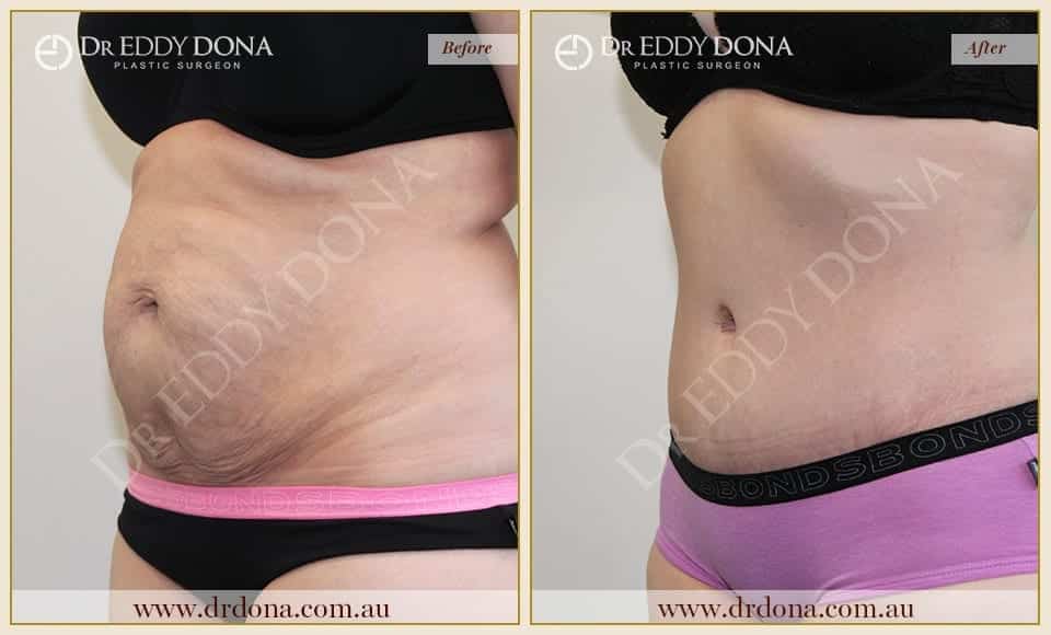 Dr Eddy Dona Plastic Surgery Tummy Tuck Before and After Left Oblique