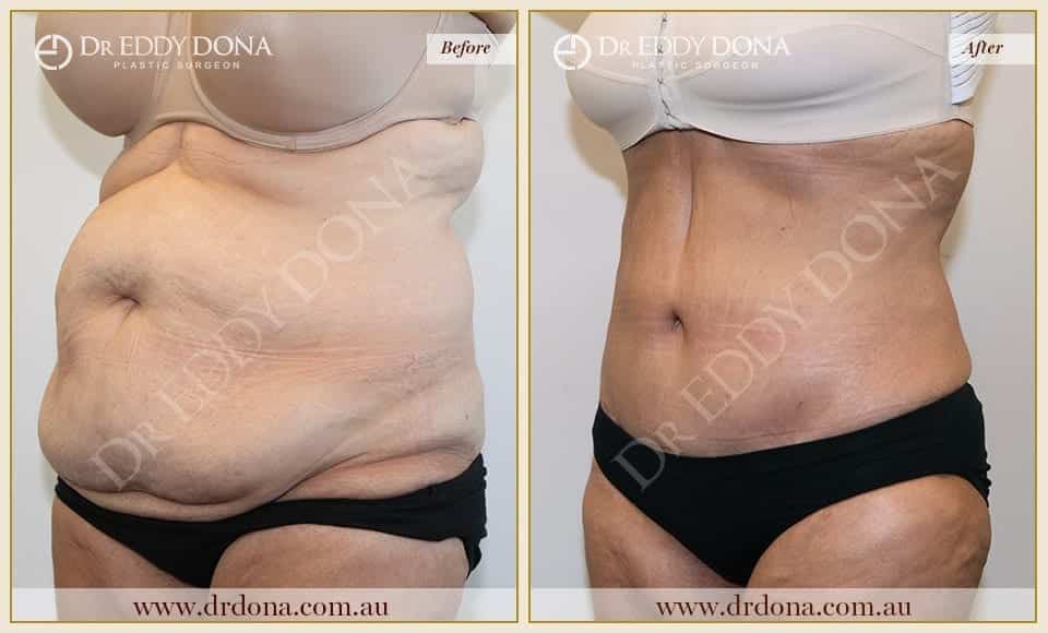 Dr Eddy Dona - Tummy Tuck Surgery - O6751 L-min