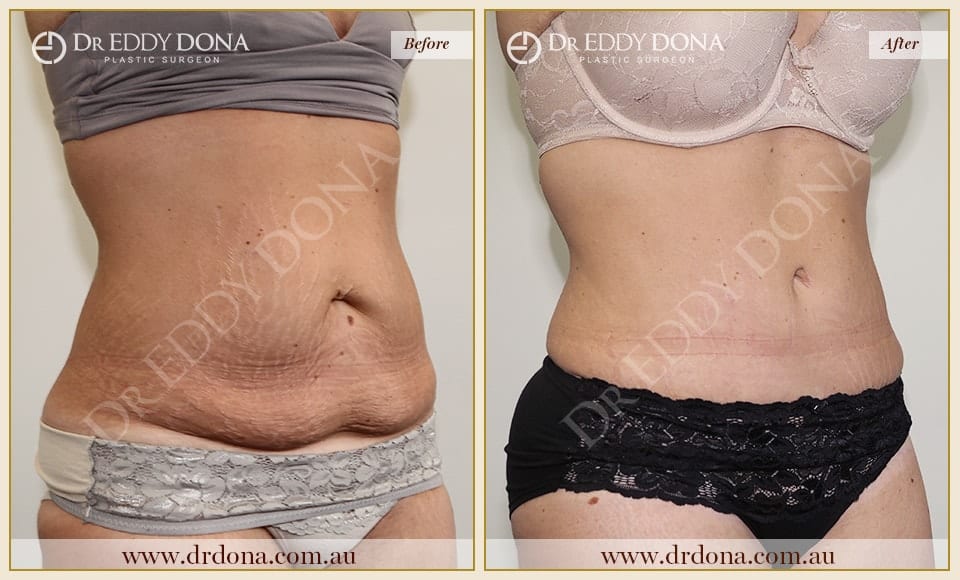 Dr Eddy Dona - Tummy Tuck - Before and After