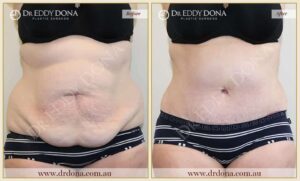 Dr Eddy Dona Plastic Surgery Tummy Tuck Before and After Frontal