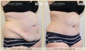 Dr Eddy Dona Plastic Surgery Tummy Tuck Before and After Right Oblique