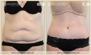 Dr Eddy Dona Plastic Surgery Tummy Tuck Before and After Frontal