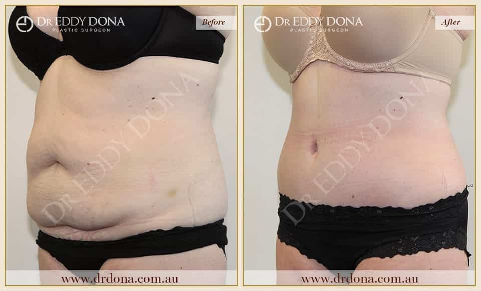 Dr Eddy Dona Plastic Surgery Tummy Tuck Before and After Left Oblique