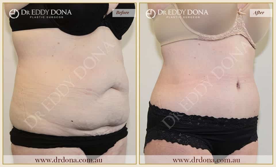 Dr Eddy Dona Plastic Surgery Tummy Tuck Before and After Right Oblique