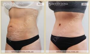 Dr Eddy Dona Plastic Surgery Tummy Tuck Before and After Left Oblique