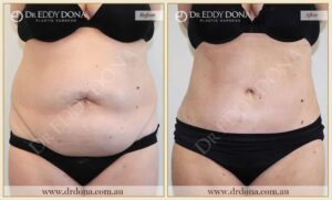 Dr Eddy Dona Plastic Surgery Tummy Tuck Before and After Frontal