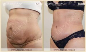 Dr Eddy Dona Plastic Surgery Tummy Tuck Before and After Left Oblique