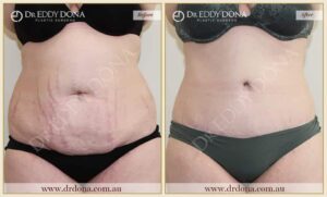 Dr Eddy Dona - Tummy Tuck Surgery - O8513 F-min