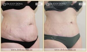 Dr Eddy Dona - Tummy Tuck Surgery - O8513 R-min