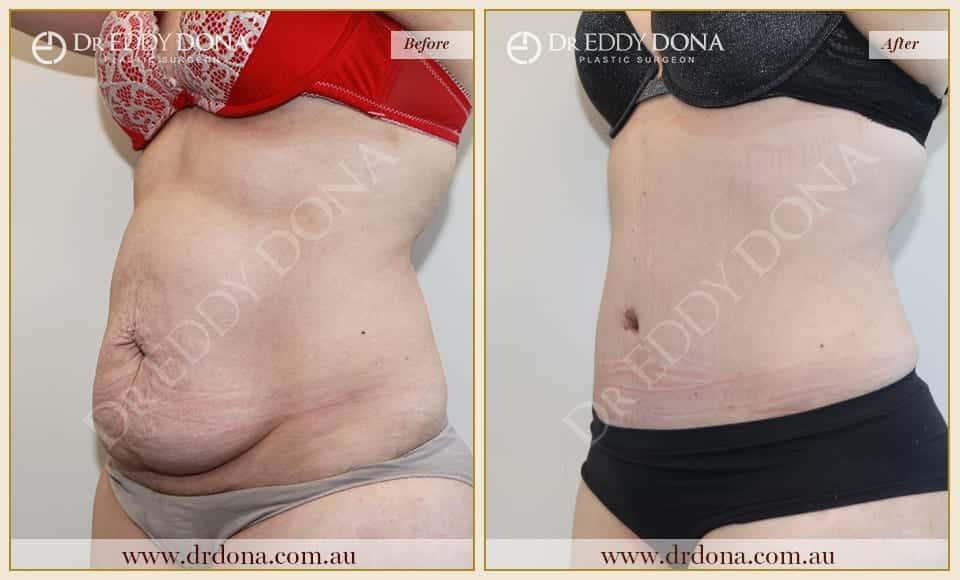 Dr Eddy Dona Plastic Surgery Tummy Tuck Before and After Left Oblique