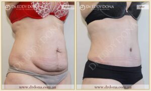 Dr Eddy Dona Plastic Surgery Tummy Tuck Before and After Right Oblique