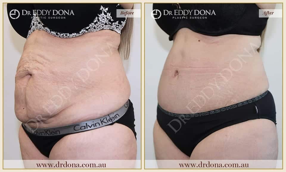 Dr Eddy Dona Plastic Surgery Tummy Tuck Before and After Left Oblique