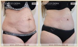 Dr Eddy Dona Plastic Surgery Tummy Tuck Before and After Right Oblique